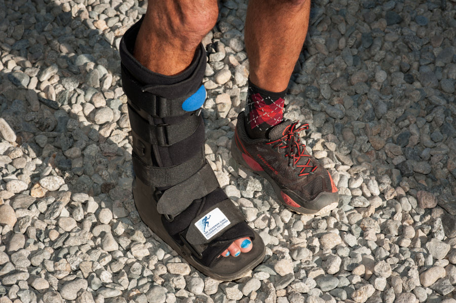 A foot with painted toenails in a protective brace