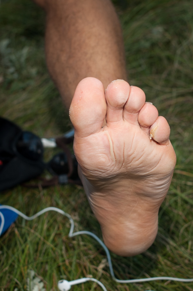 Blisters on a racer's foot